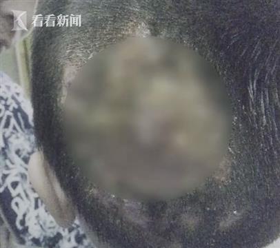 9岁女孩养猫后 真菌感染恐永久脱发