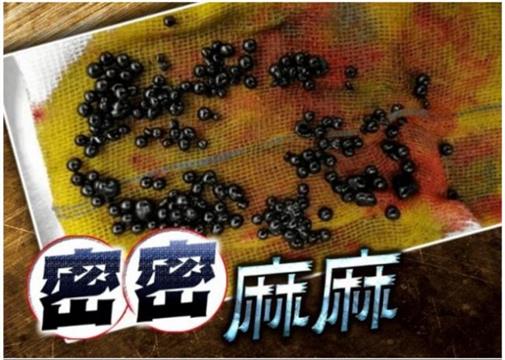 浙江15岁仔不良饮食致胆囊生逾百颗结石